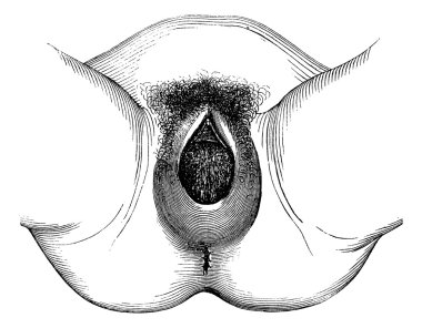 perineal şişkinlik ve dilatasyon, antika gravür,